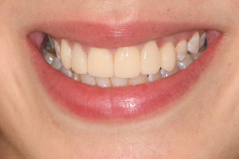 After image