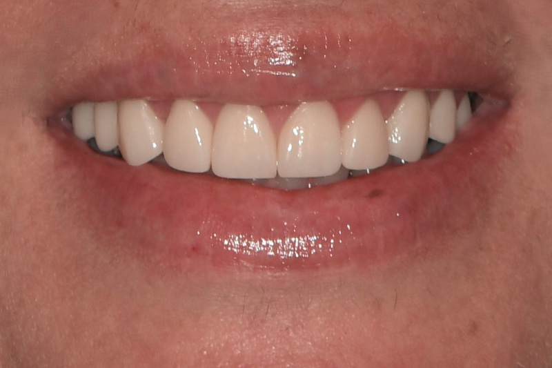 After image